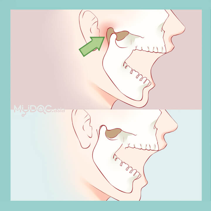 颞下颌关节(temporomandibular joint)的治疗方法,这会让控制下颌
