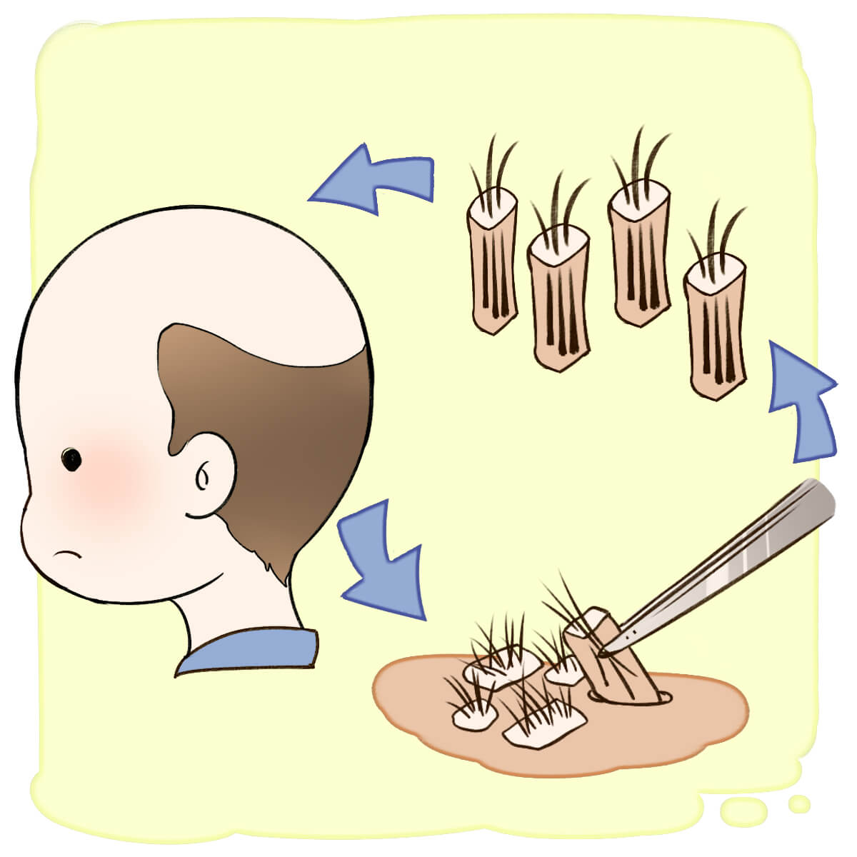 Follicular Unit Extraction FUE