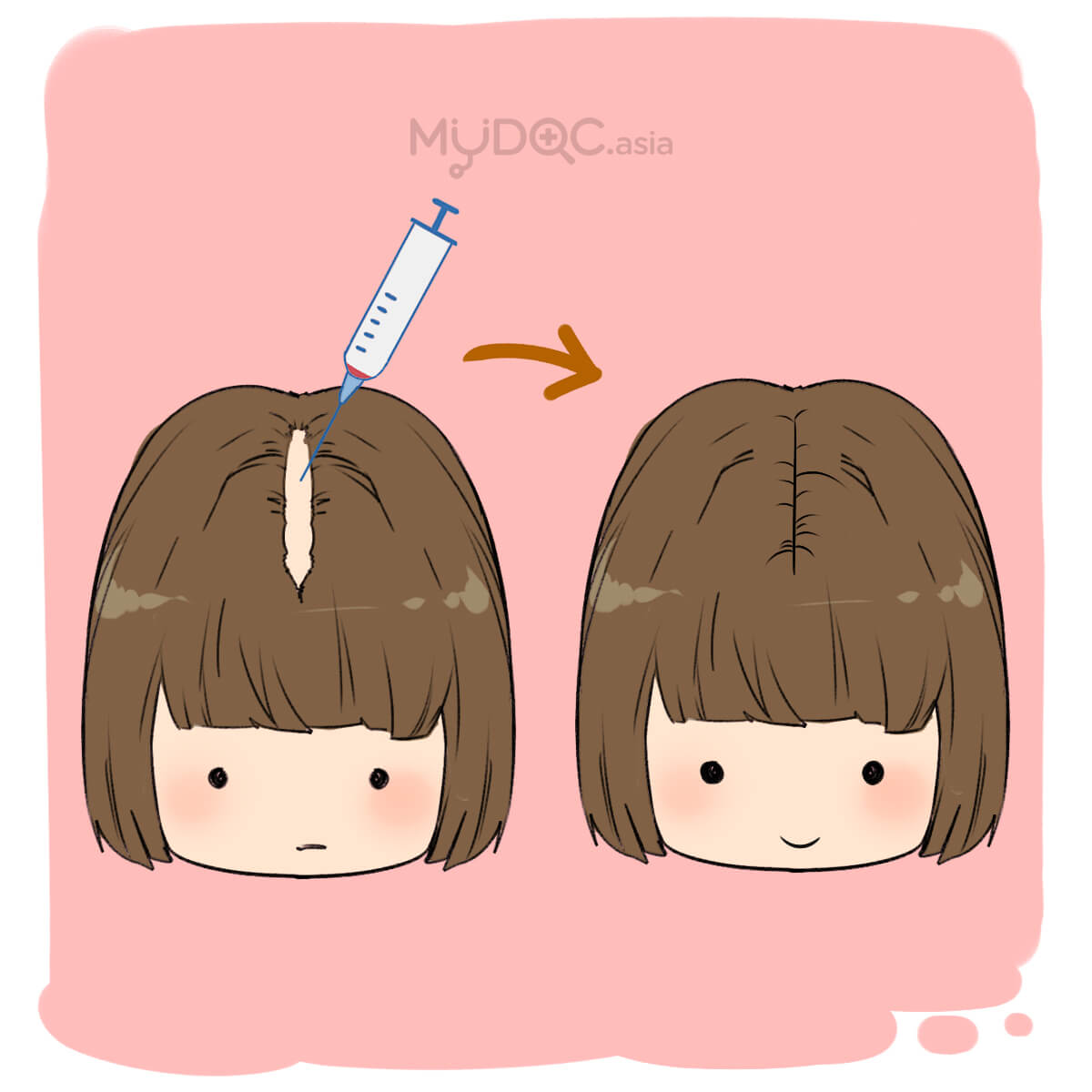 Mesotherapy for hair loss