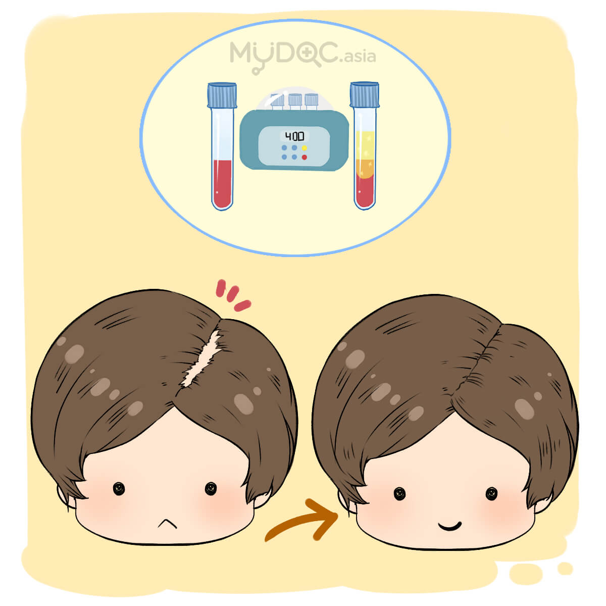 Platelet-rich plasma, PRP treatment for hair loss