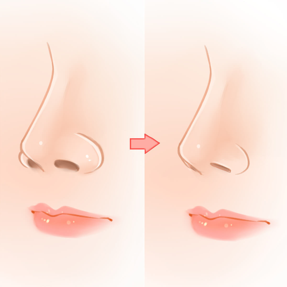 Alarplasty