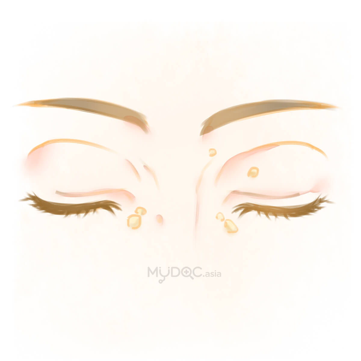 Xanthelasma is one of the common Xanthoma. These are skin bumps found around your eyes, and are usually symmetrical.