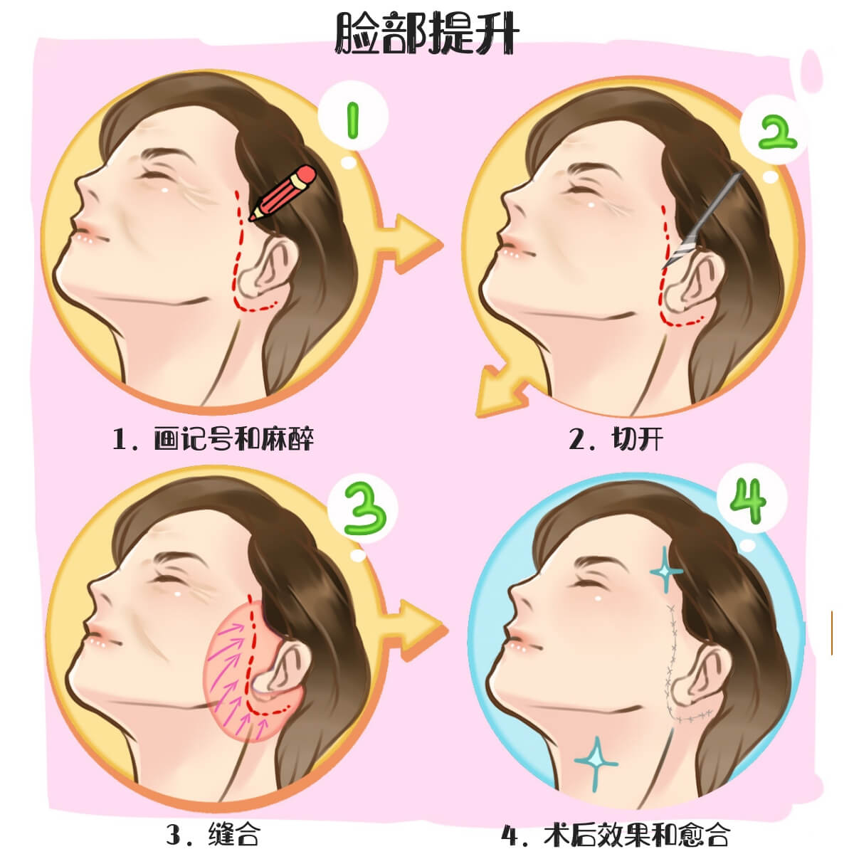 V-Shape Face Procedure