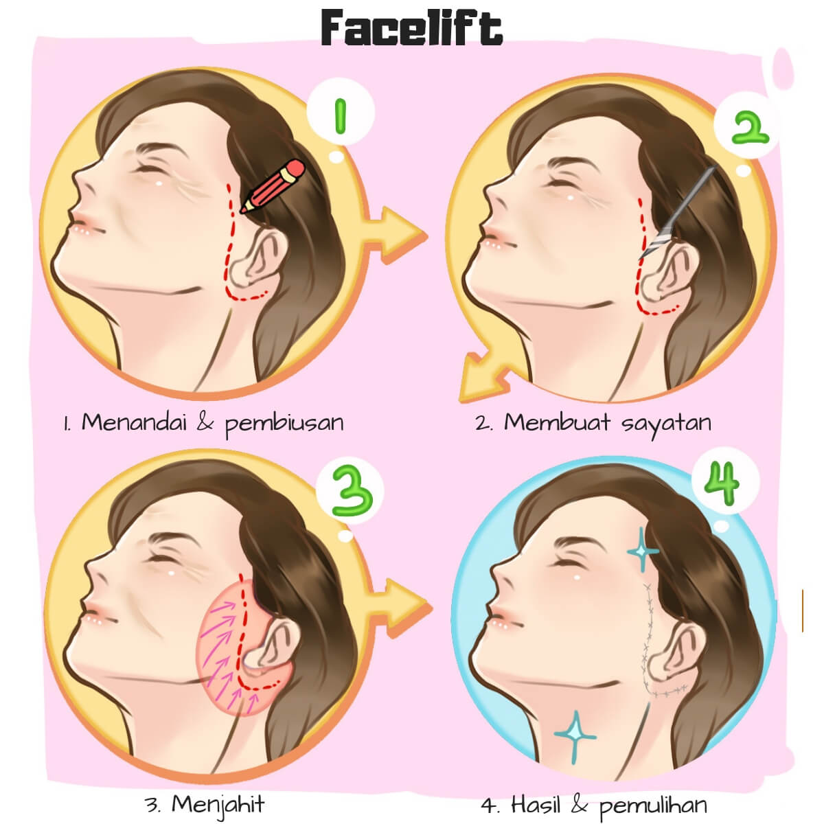V-Shape Face Procedure