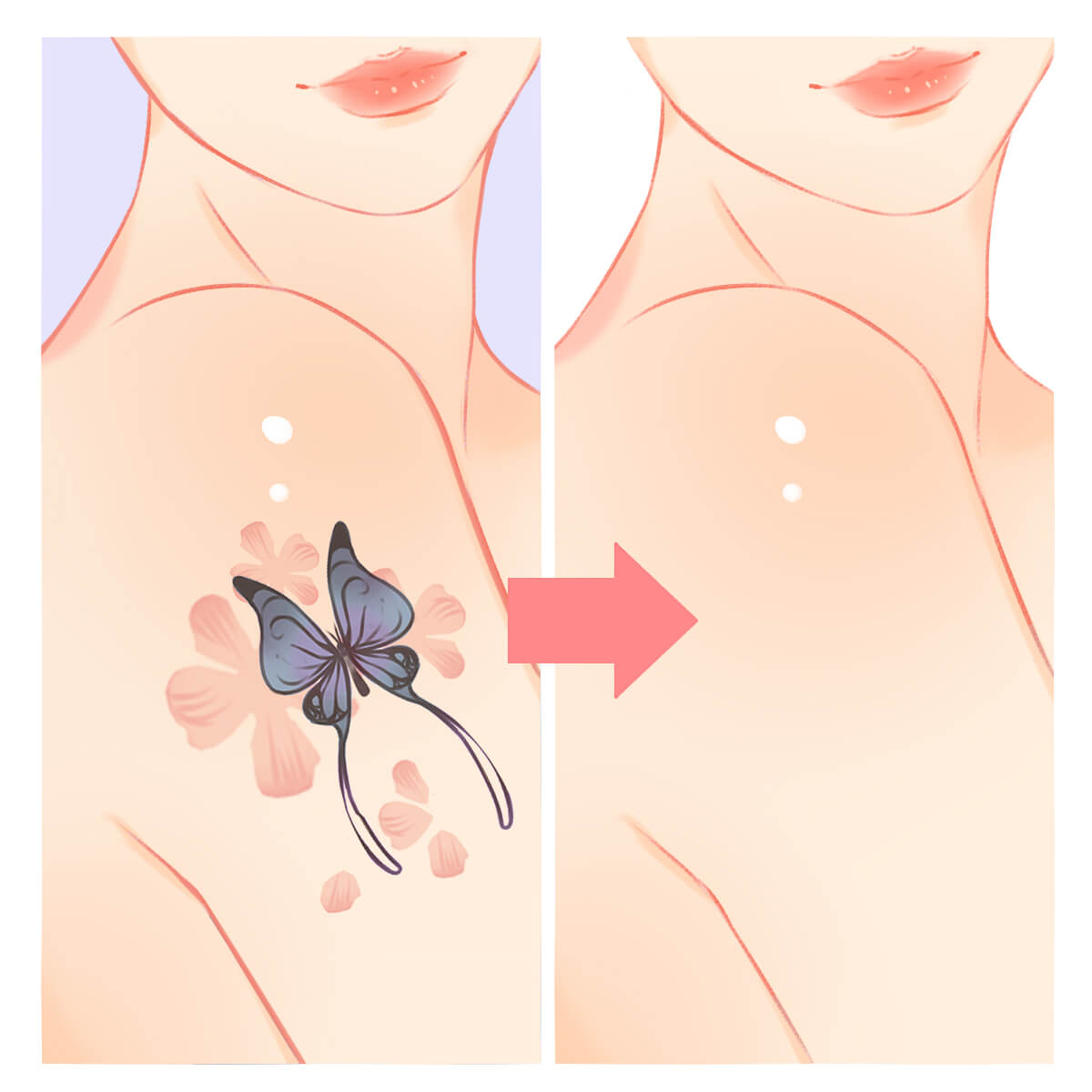 Tattoo removal