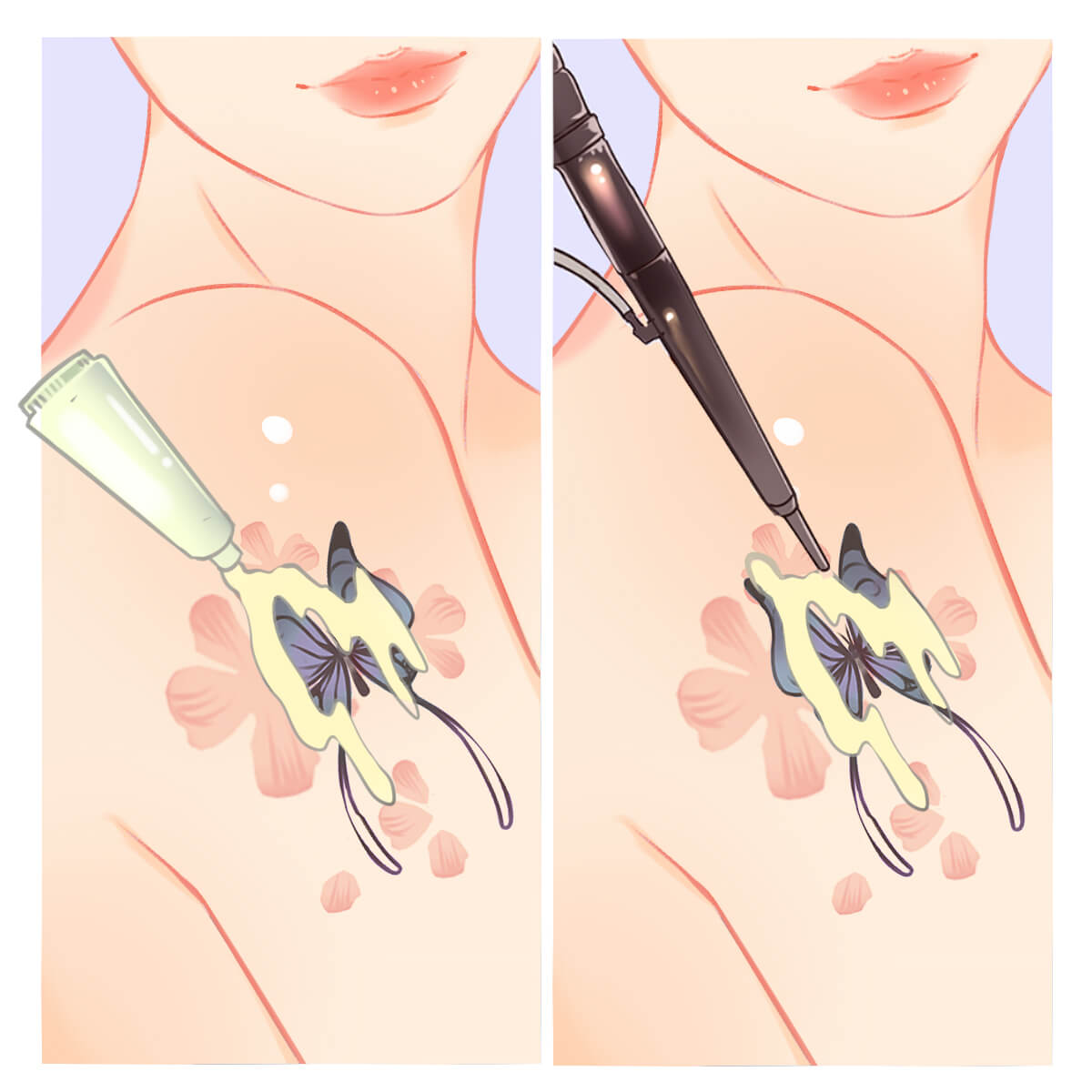 Laser tattoo removal