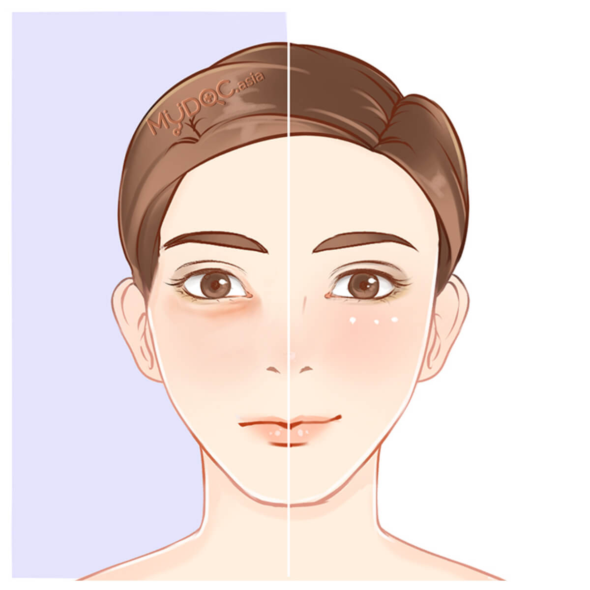 Eyebag Treatment