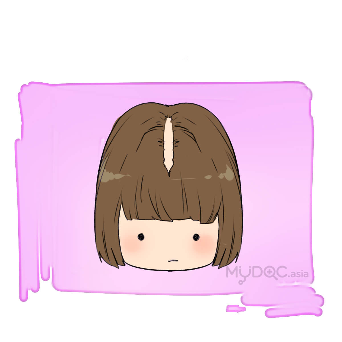 Hairline gap hair loss