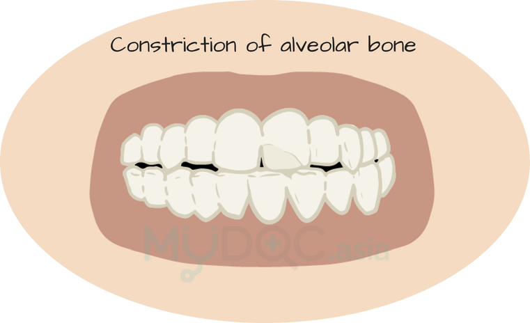 Constriction of alveolar bone can affect braces treatments