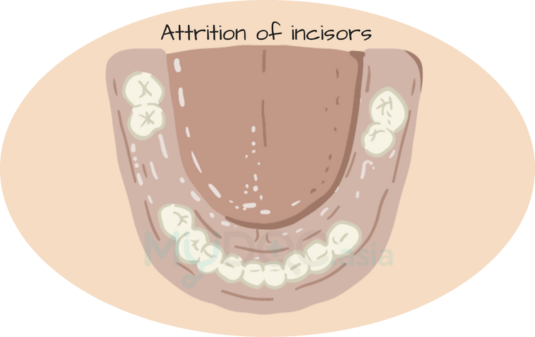 Attrition of incisors can affect braces treatment