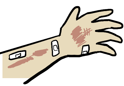Easy bruises as a symptom of liver damage