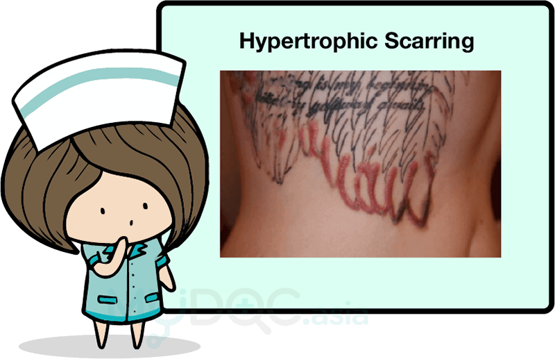 What's New on Tattoo Removing Laser for Malaysia in 2017? | Erufu Care
