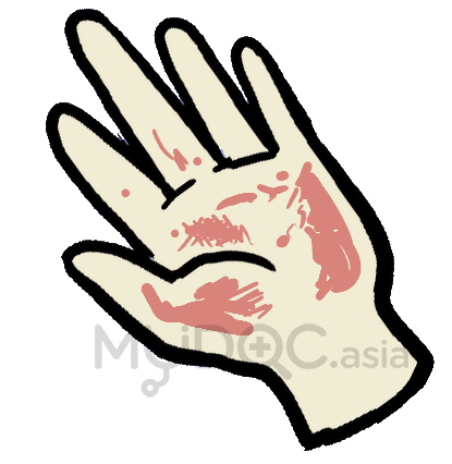 Skin irritation or liver skin as a symptom of liver damage