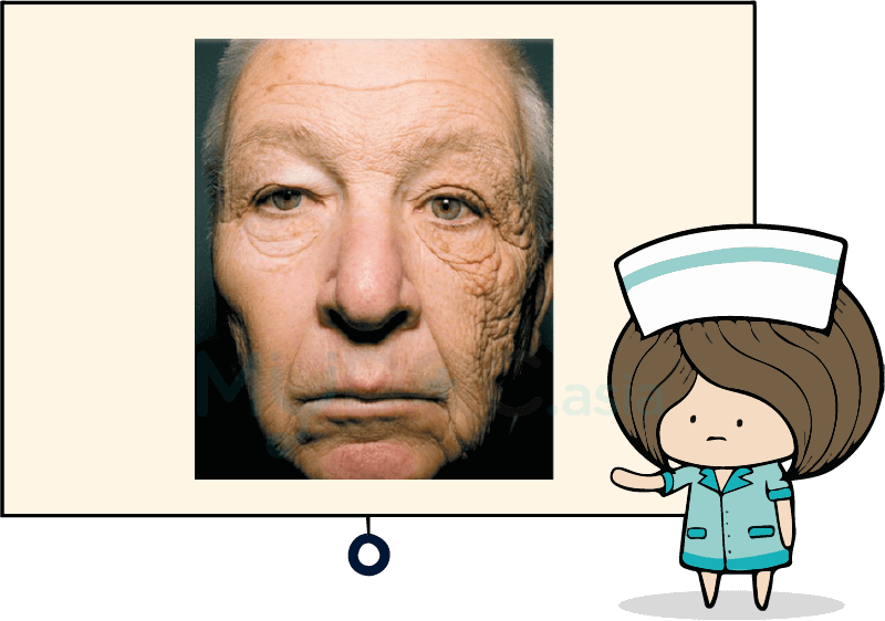 Not apply sunblock for 28 year,skin damage