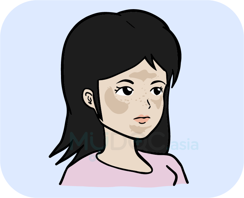 Melasma on face