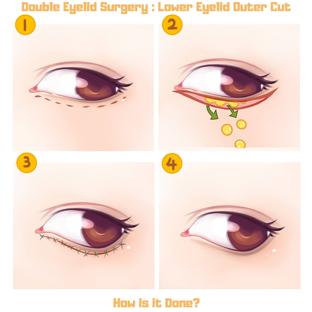 Double eyelid surgery: lower eyelid outer cut