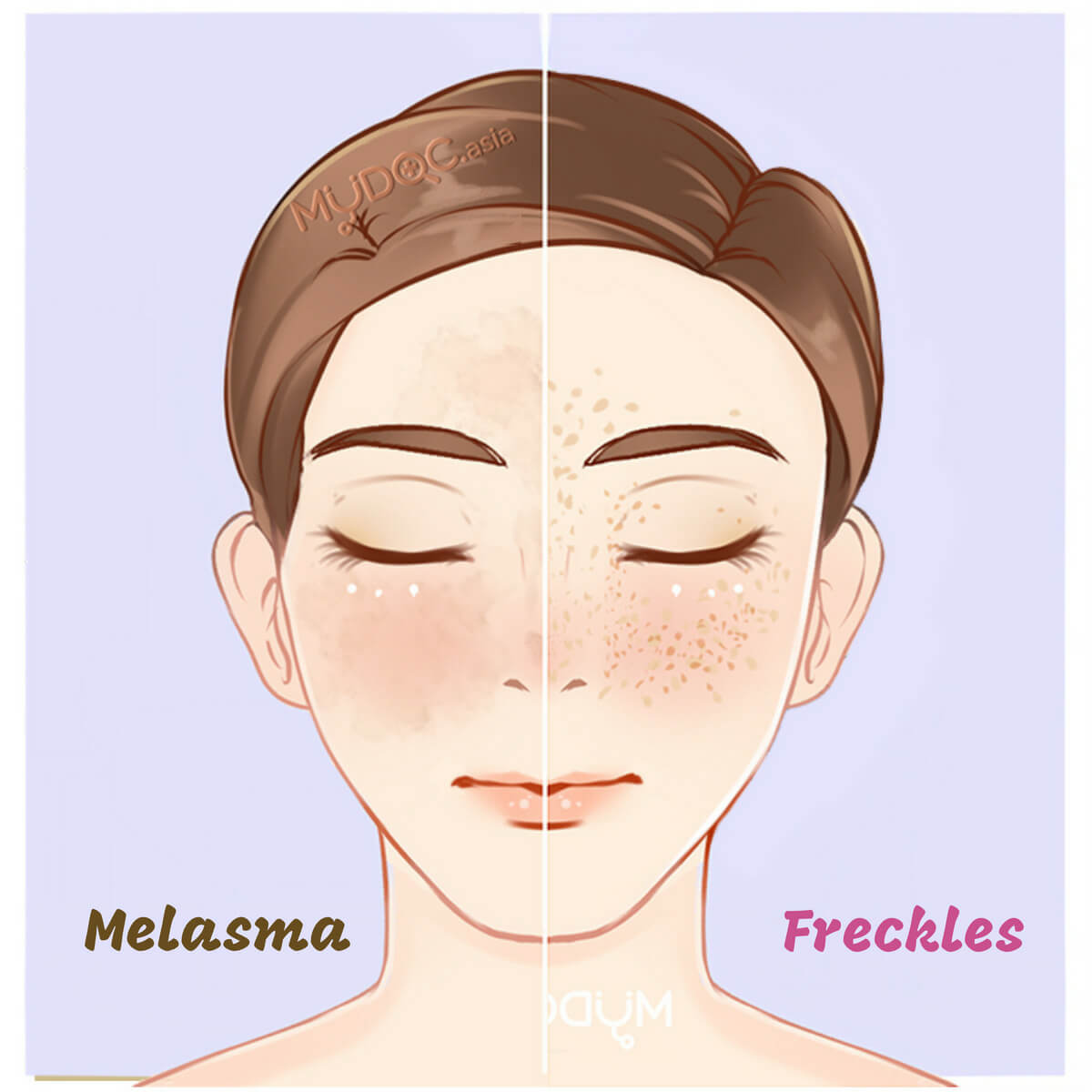 Melasma vs Freckles