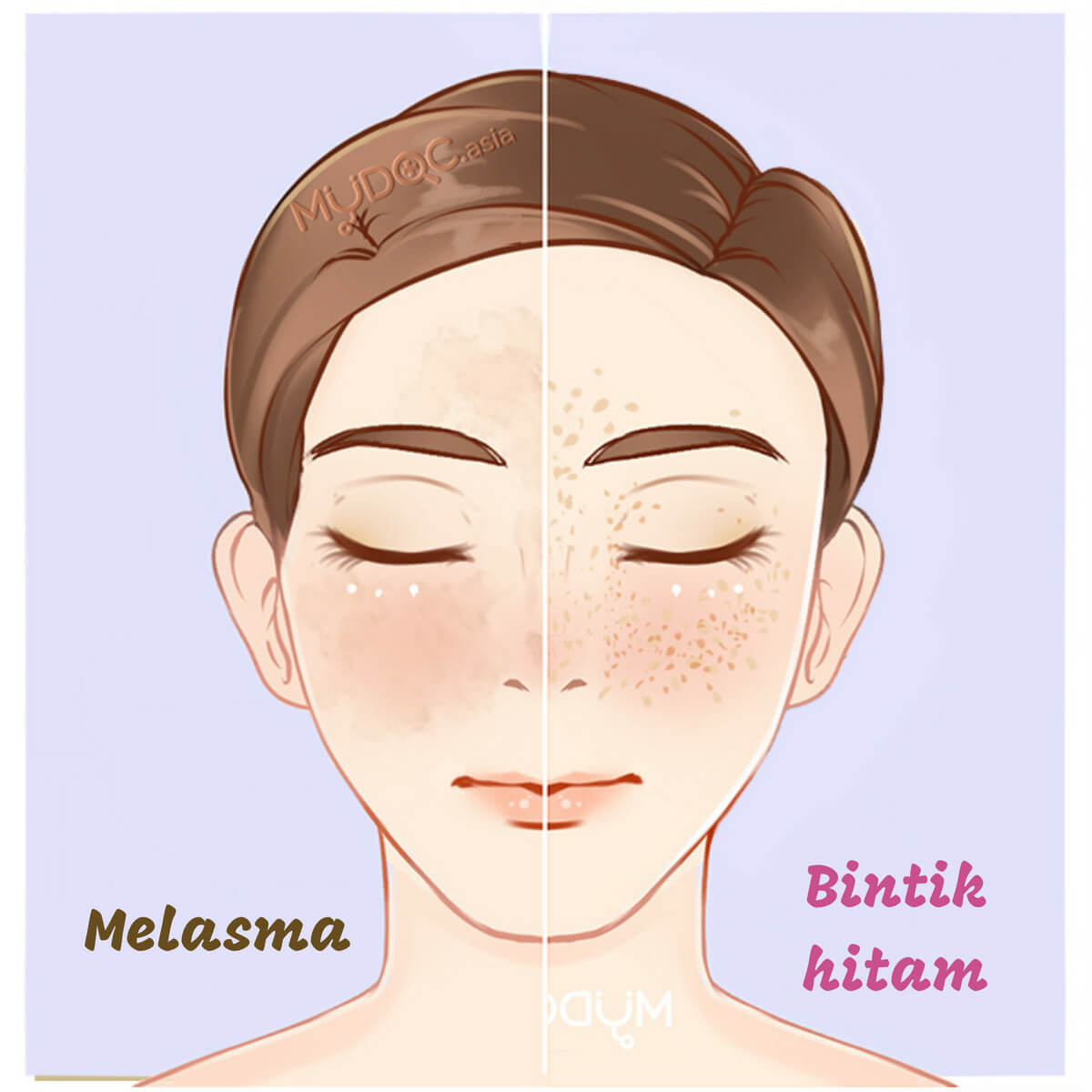 Freckles vs Bintik Hitam