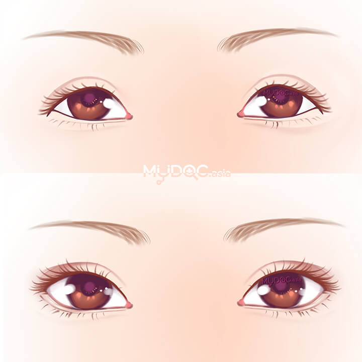 Canthoplasty