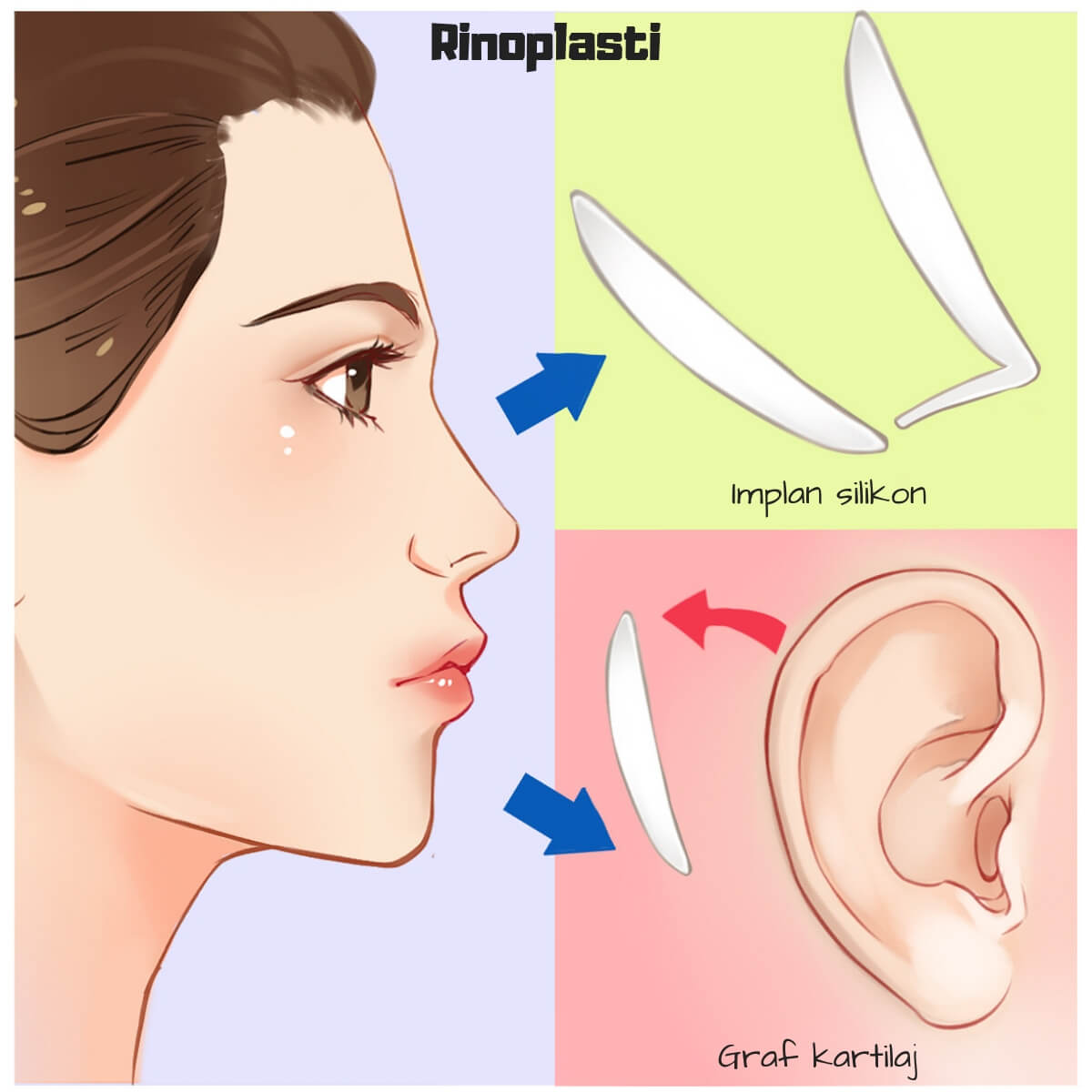 Rhinoplasty types