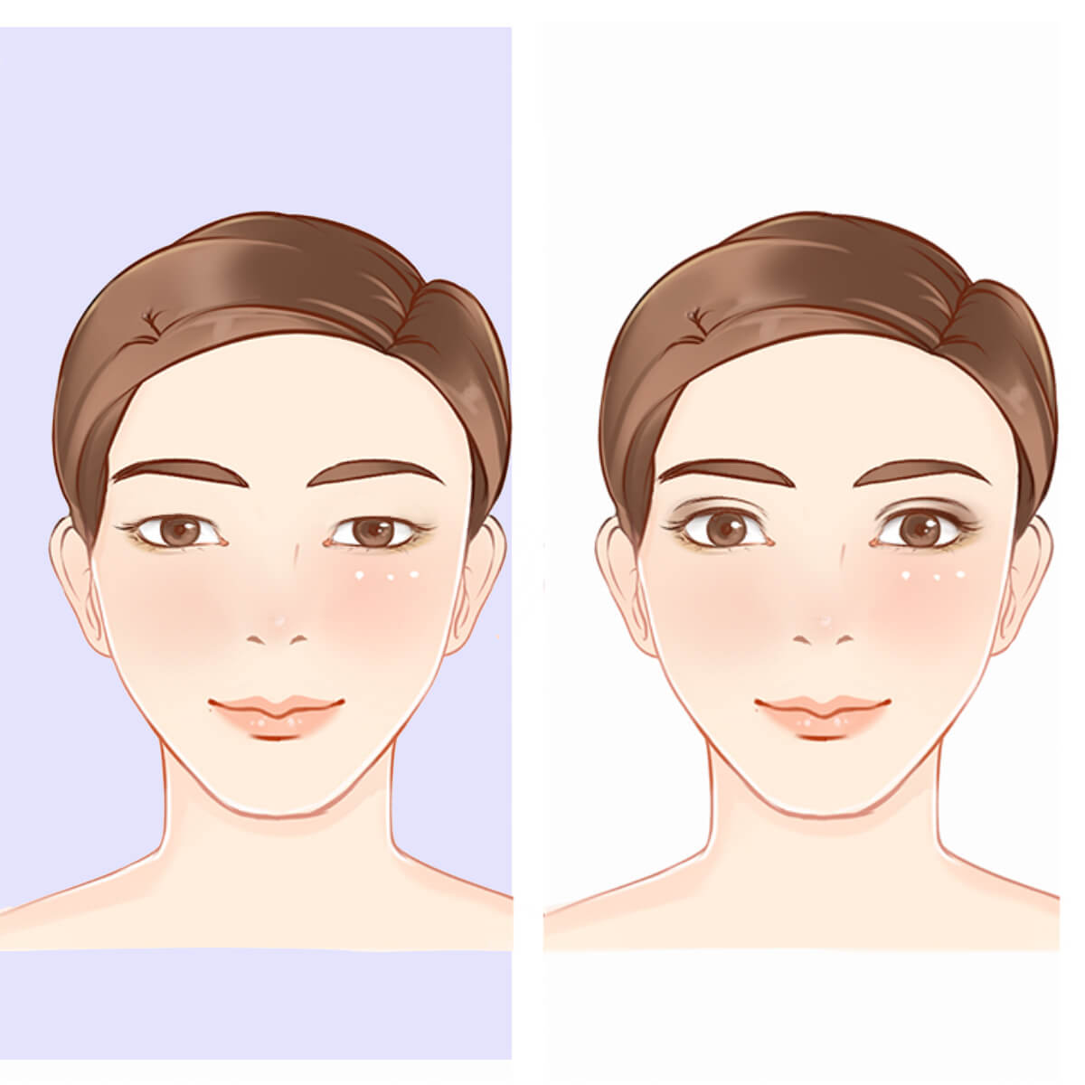 Single eyelids to double eyelids
