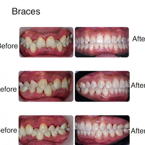Dental Braces
