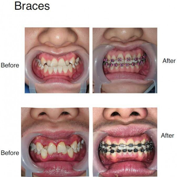 Dental Braces