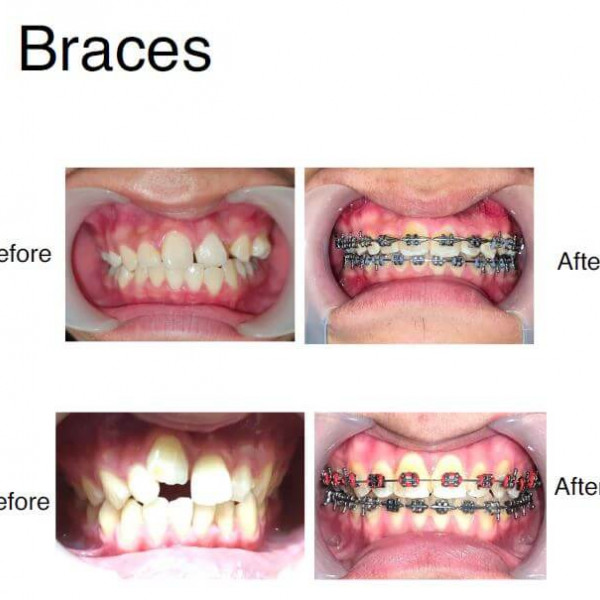 Dental Braces