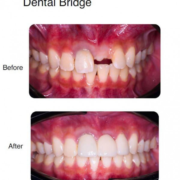 Dental Bridge