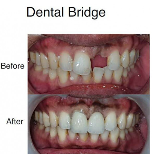 Dental Bridge