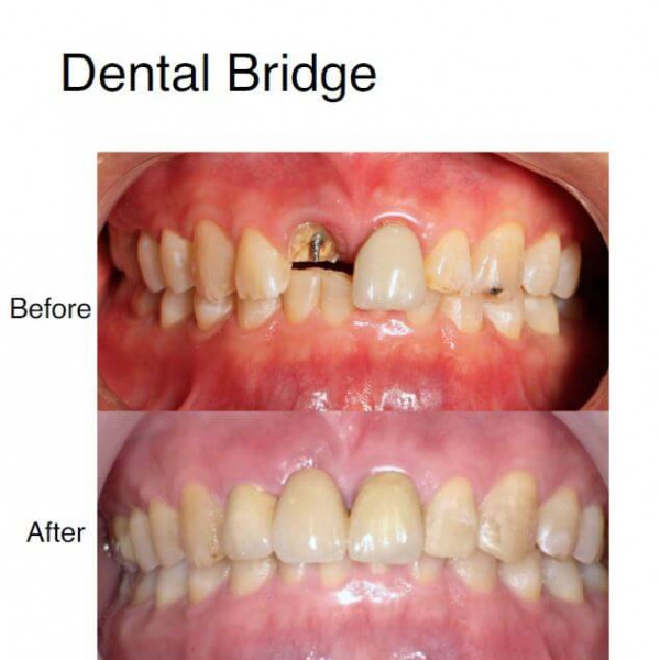 Dental Bridge