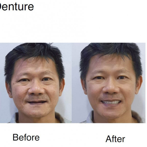 Denture