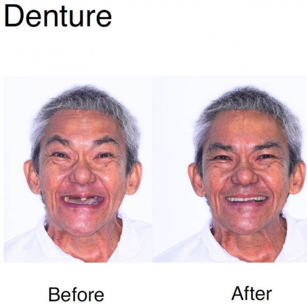 Denture