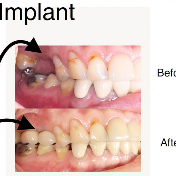 Dental Implant