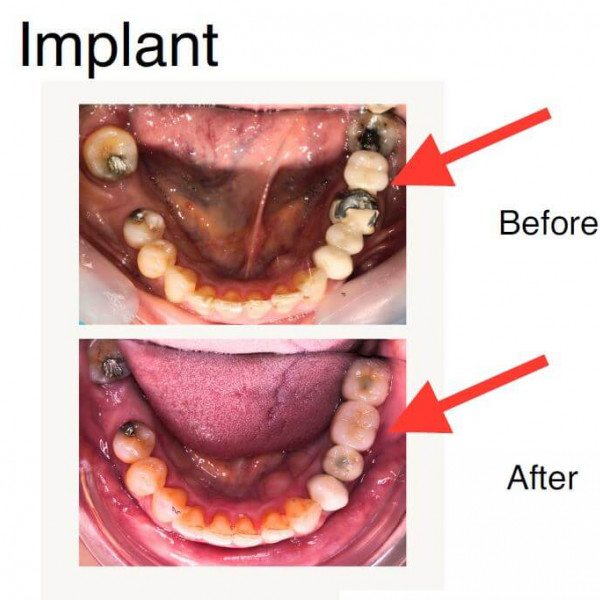 Dental Implant