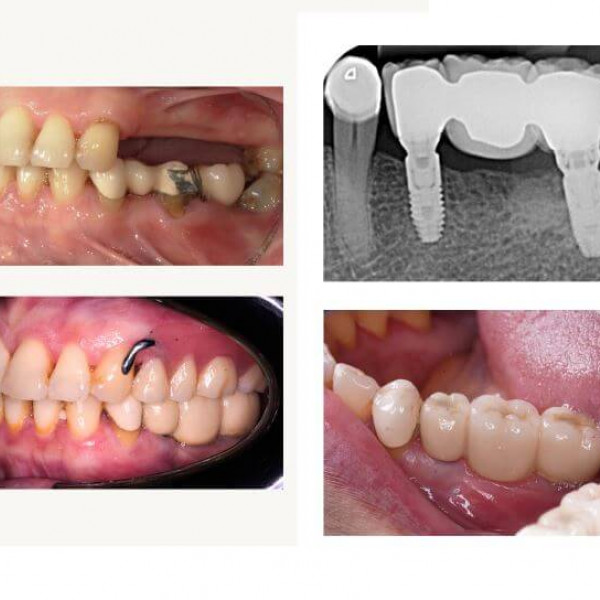 Dental Implant