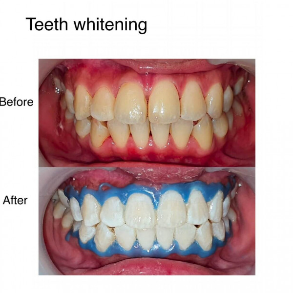 Teeth Whitening