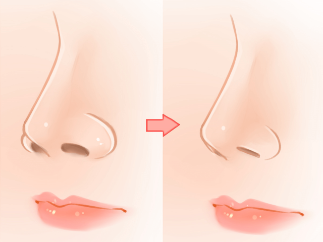 What Are the Different Types of Rhinoplasty?
