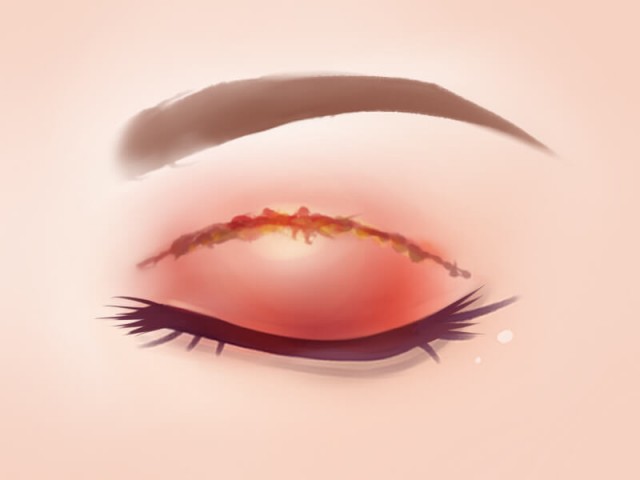 What are the Risks and Side Effects of Double Eyelid Treatments?