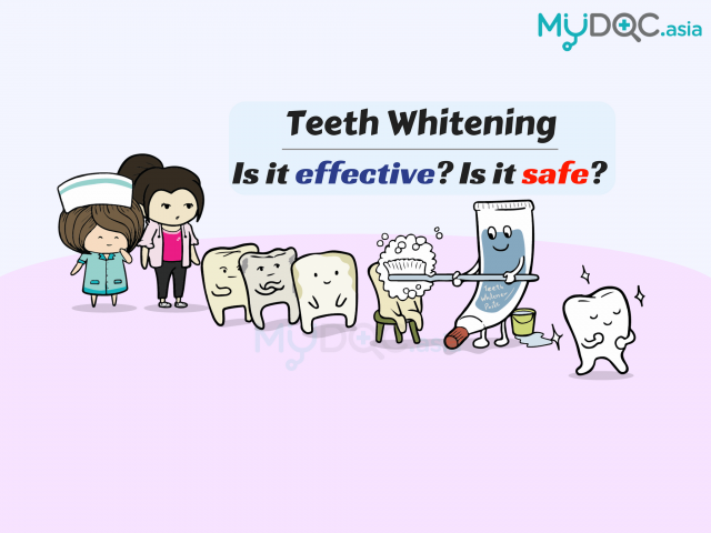 Does Teeth Whitening Work and Is It Safe?