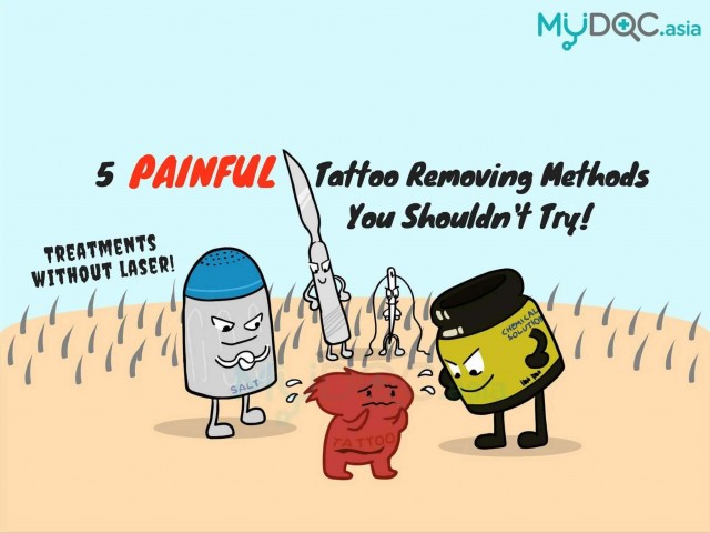 5 Painful Non-Laser Tattoo Removing Methods You Shouldn’t Try!