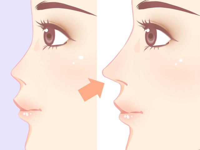 Rhinoplasty or Non-Surgical Nose Jobs?