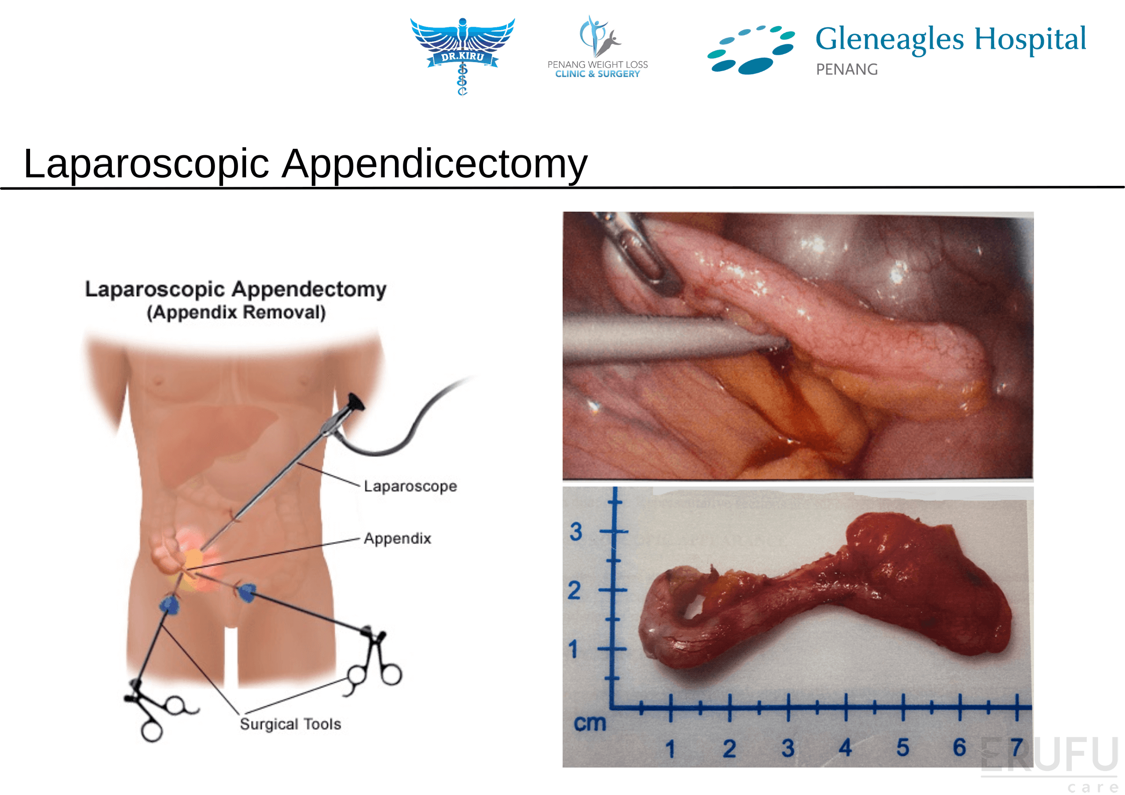 All You Ever Wanted To Know About Piles - Penang Surgeon