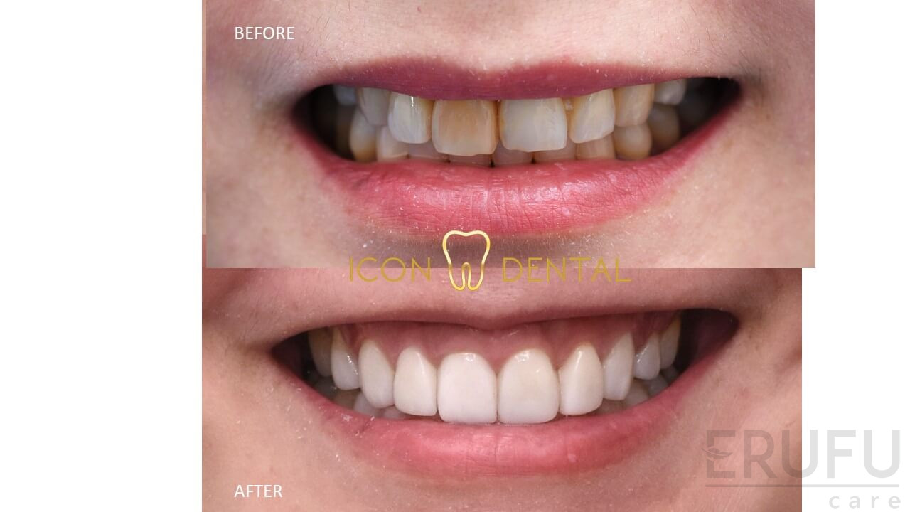 Tooth Colored Fillings - Alan G. Chui, DDS