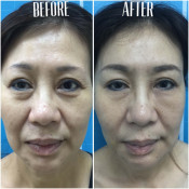 Before After - 6 SenZ facial sculpure (Temporal, Undereye, Cheek Fillers & BTA crow's feet)