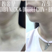 Before After - Indiba Neck & BTA Chin