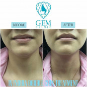 Before After - Indiba Double Chin