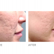 89 Klinik Laser Menghilangkan Bulu Terbaik Malaysia - Harga u0026 Ulasan