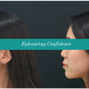 Dermal Fillers