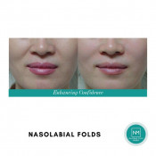 Dermal Fillers